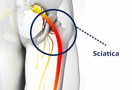 Sciatic nerve irritation. What is it and why should I have it treated?